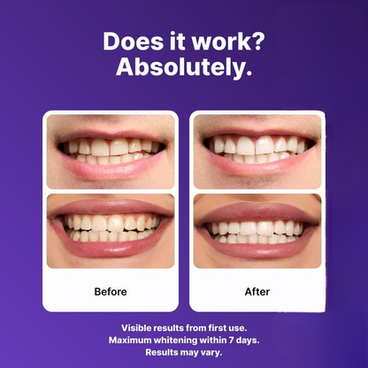 SaferSmile™ Purple Whitening Strips